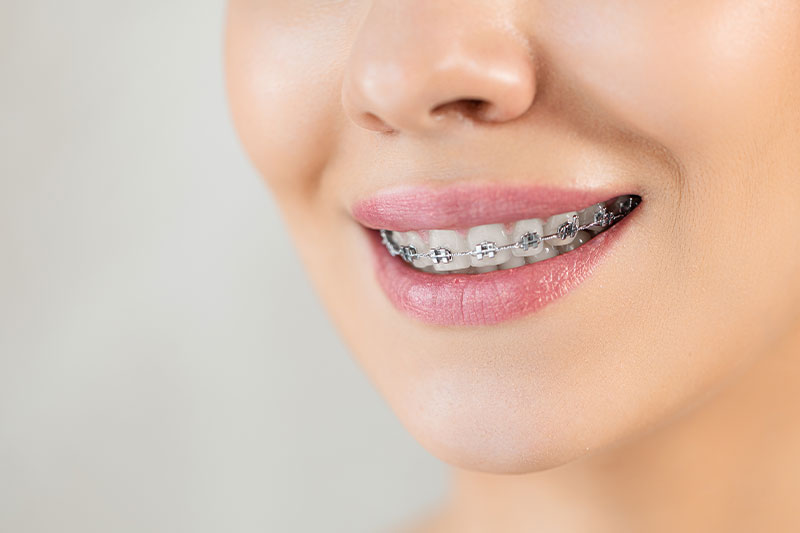 Braces in Torrance