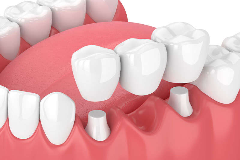 Dental Bridges in Torrance