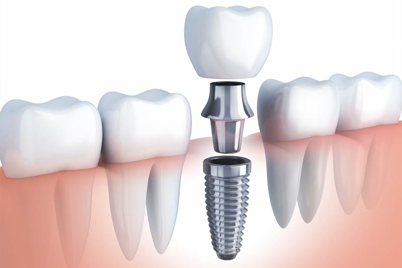Dental Implants in Torrance