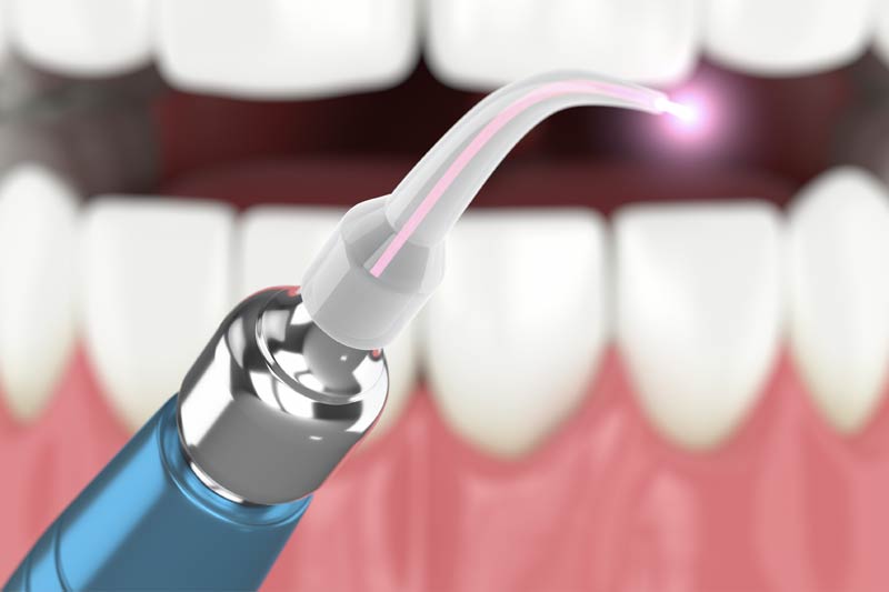 Laser Periodontal Therapy in Torrance