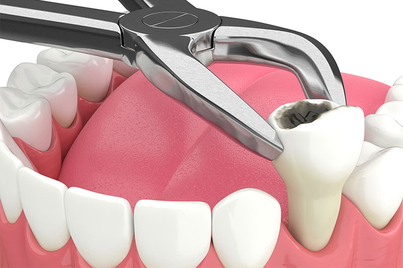 Tooth Extractions in Torrance